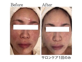 エラフリー/毎日の洗顔でも悪化しやすい肌に