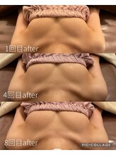 アネラ 京都駅前店(Anela)/【16回コース途中経過　after】