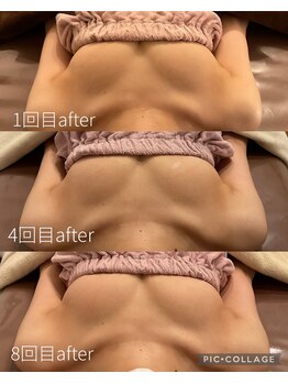 アネラ 京都駅前店(Anela)/【16回コース途中経過　after】