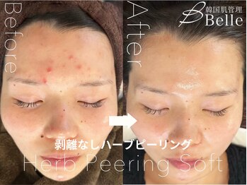 ベル 渋谷(belle)/ハーブピーリング|ニキビケア
