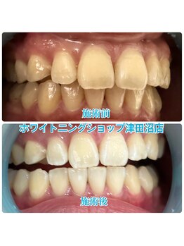 ホワイトニングショップ 津田沼店/before&after美白ホワイトニング