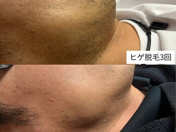 メンズ脱毛 千歳/ヒゲ脱毛3回
