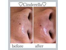 シンデレラ しみケア(Cinderella)/毛穴洗浄＋Wax＋毛穴縮小マシン