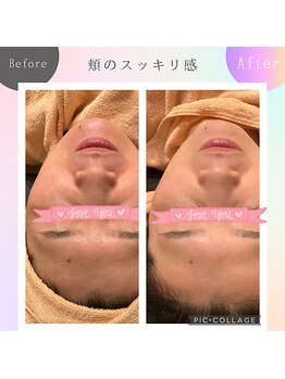 パルティノ 高崎店/【症例】毛穴洗浄・毛穴ケア