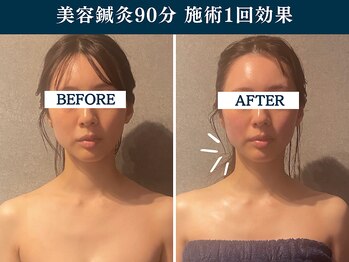 シンク(CINQ)/美容鍼灸90分韓国肩リフトアップ