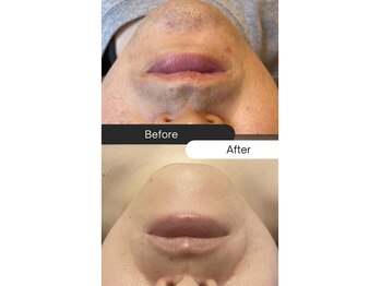 サボ 福岡(SAVO)/【ヒゲ脱毛12回】