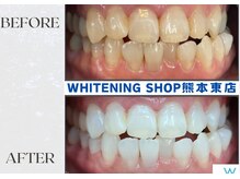 ホワイトニングショップ熊本東店/ホワイトニングショップ熊本東店