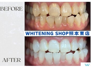 ホワイトニングショップ熊本東店/ホワイトニングショップ熊本東店