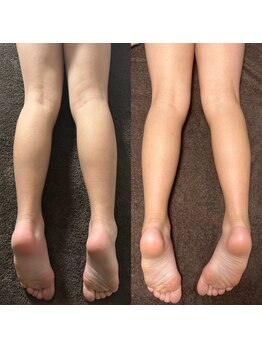 リンデザ(Lindeza)/むくみスッキリ