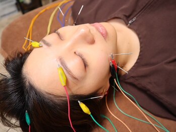 やす鍼灸院の写真/【美容鍼でむくみ×たるみケア☆】電気美容鍼で表情筋を引き上げ横顔美人♪また身体の不調にも鍼が最適!!