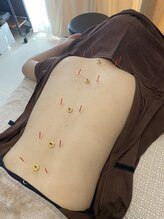 アキュリス(aquliss)/自律神経 × 鍼