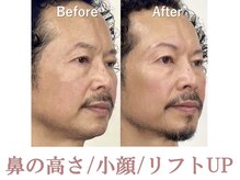 ラプリ 盛岡店(Raplit)/隆鼻＋輪郭矯正40分20回