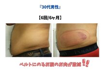 ビーレボリューション(B-REVOLUTION)/男性のお腹冷却！