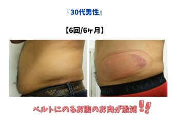 ビーレボリューション(B-REVOLUTION)/男性のお腹冷却!