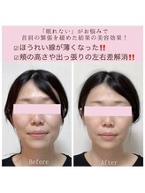 ビーホリック(Bholic)/頬やフェイスラインのゴツゴツ感