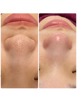 パールプラス 行橋店/脱毛＋フェイシャルで肌質改善★