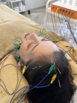 ユララ(YURARA)/ニキビケアに美容鍼！！