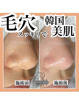 ナチュラリー(Naturally)/毛穴エクストラクション