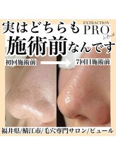 ピュール 鯖江店(PUR)/毛穴サロン/毛穴ケア/毛穴洗浄