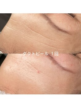 ソアン(Soin)/ダクトピール