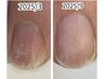 【縦割れ矯正】縦割れ悩みの方、亀裂補修、細胞活性美容機器使用★お試し価格