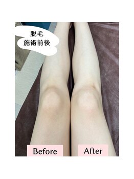 ビオラス(VIOLUS)/☆施術比較写真☆美肌脱毛/脚