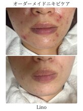 リノ(Lino)/ニキビケア