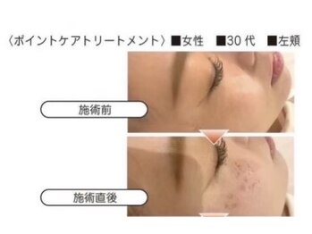 クリニカルホワイトケア 和泉府中店(クリニカルWHITEケア)/シミケア施術前と直後