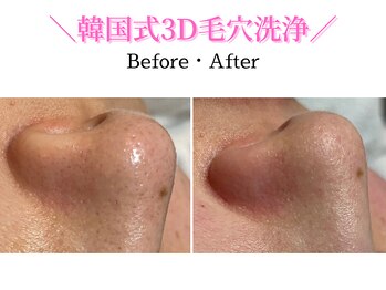 ダイヤモンド リーエンダ(Diamond leende)/韓国式3D毛穴洗浄