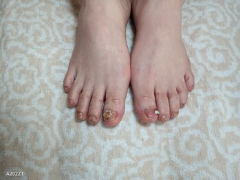 イーズ(ease)/フット ピンクラメ クリスマス