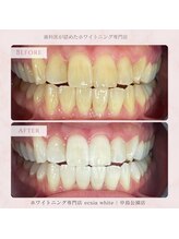 エクシアホワイトニング 札幌中島公園店/Before After［ホワイトニング］