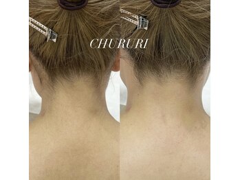 チュルリ 新町店(Chururi)/うなじ/うなじワックス脱毛