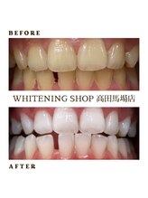ホワイトニングショップ 高田馬場店/ホワイトニングBefore After