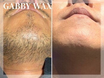 ギャビーワックス(GABBY WAX)/☆ヒゲ脱毛☆