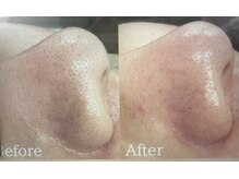 エヌフェイシャル(N.facial)/小鼻ピーリング♪