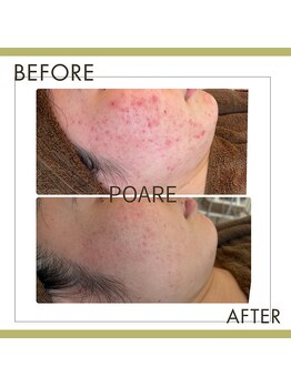 ポアレ(POARE)/赤みが引かなくて悩んでた