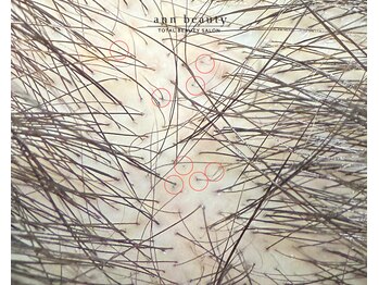 アン ビューティー(ann beauty)/施術3回【症例写真】40代