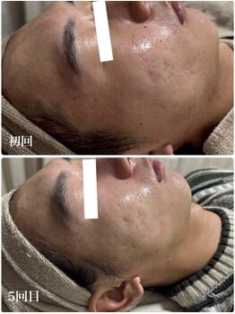 ビズビズ(bisebise)/創業24年！メンズニキビ改善専門