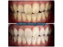 ホワイトニングショップ 天王寺店/40分照射×10回 30代女性