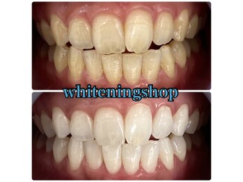 ホワイトニングショップ 天王寺店/40分照射×10回 30代女性