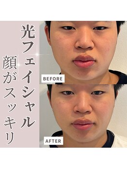 シーズボーテ(C's Beaute)/男性の光フェイシャルも人気です