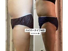 リノ(Lino)の雰囲気（キャビテーション＆ハイパーナイフ痩身メニューも豊富です！）