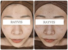 エステティック レイビス 青森店(RAYVIS)/トーンアップも出来る美肌顔脱毛