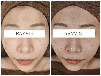 エステティック レイビス 青森店(RAYVIS)/トーンアップも出来る美肌顔脱毛