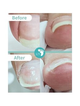 リフト 有楽町店(Re:ft)/巻き爪症例