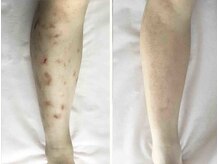 ノットノット 自由が丘(Not Knot)の雰囲気（グリーンピールボディ1day×リンパストレッチ/虫刺され跡ケア）