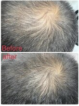 ニューユー(NewYou)/ノアグロウスカルプ