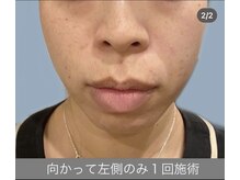 エラフリー/効果が分かりやすい半顔ケア↑