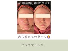 G/Hボディメイキング/プラズマシャワーニキビシミケア