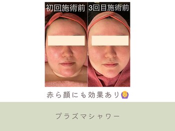 G/Hボディメイキング/プラズマシャワーニキビシミケア